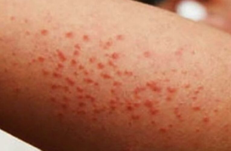 Brote de sarampión: Ssa reporta 23 fallecimientos