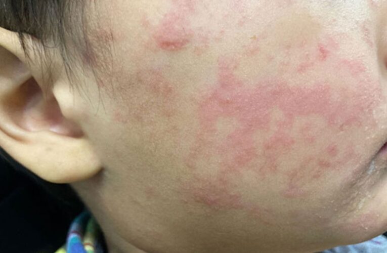 Suman 32 fallecimientos por sarampión