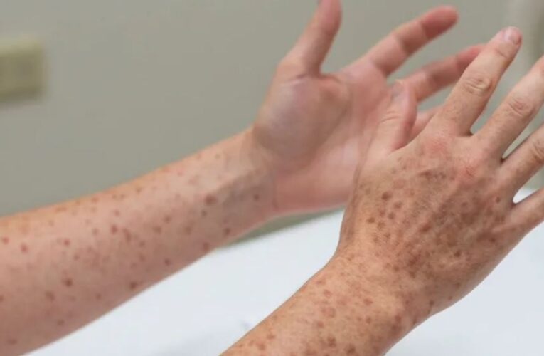 Prohíben visitas a centro de detención de migrantes en Texas por brote de sarampión