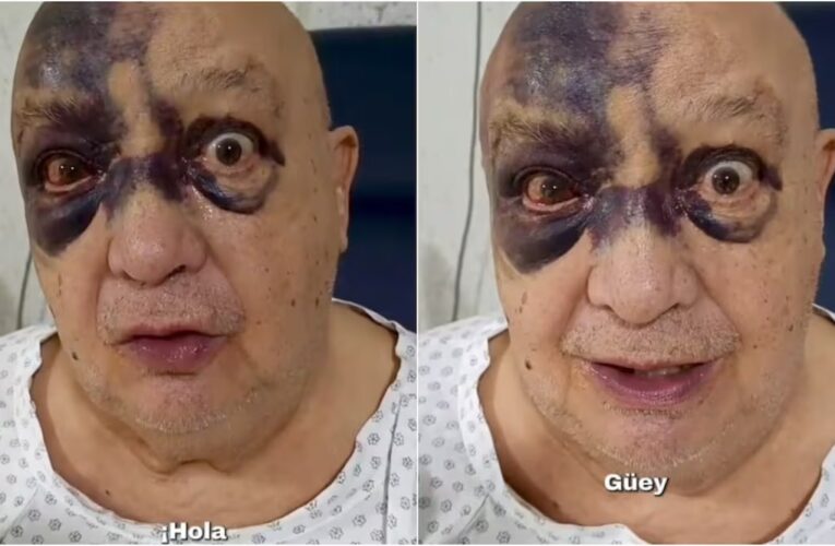 Luis de Alba preocupa tras accidente; reaparece con el rostro cubierto de hematomas